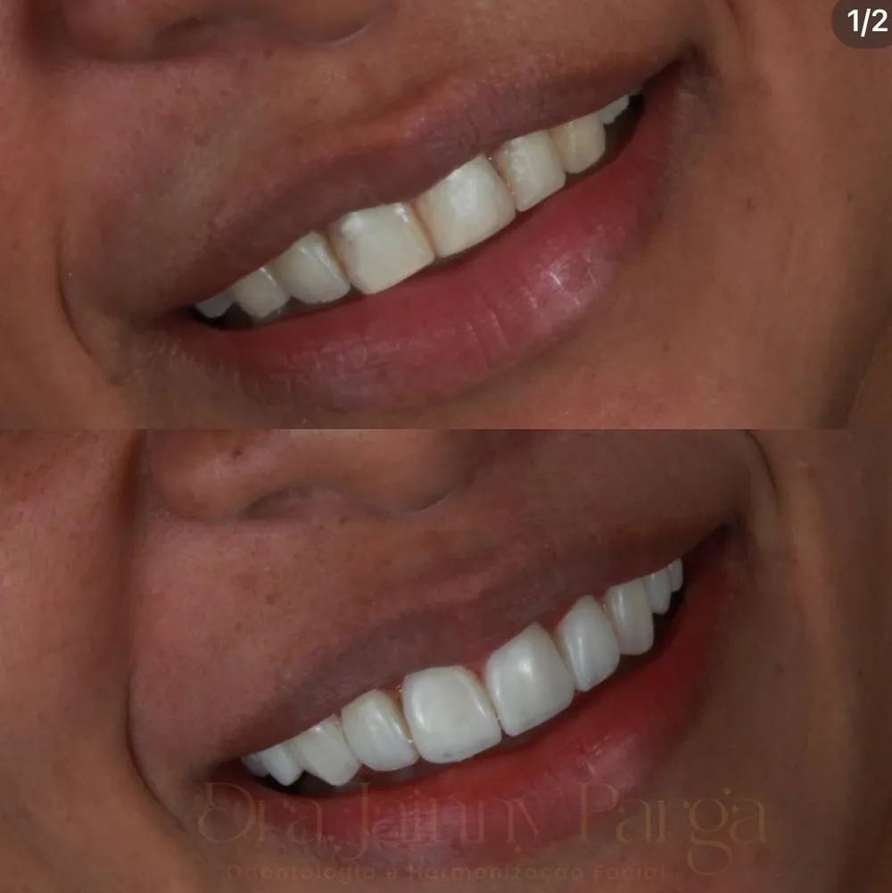 Sorriso antes e depois das facetas em resina