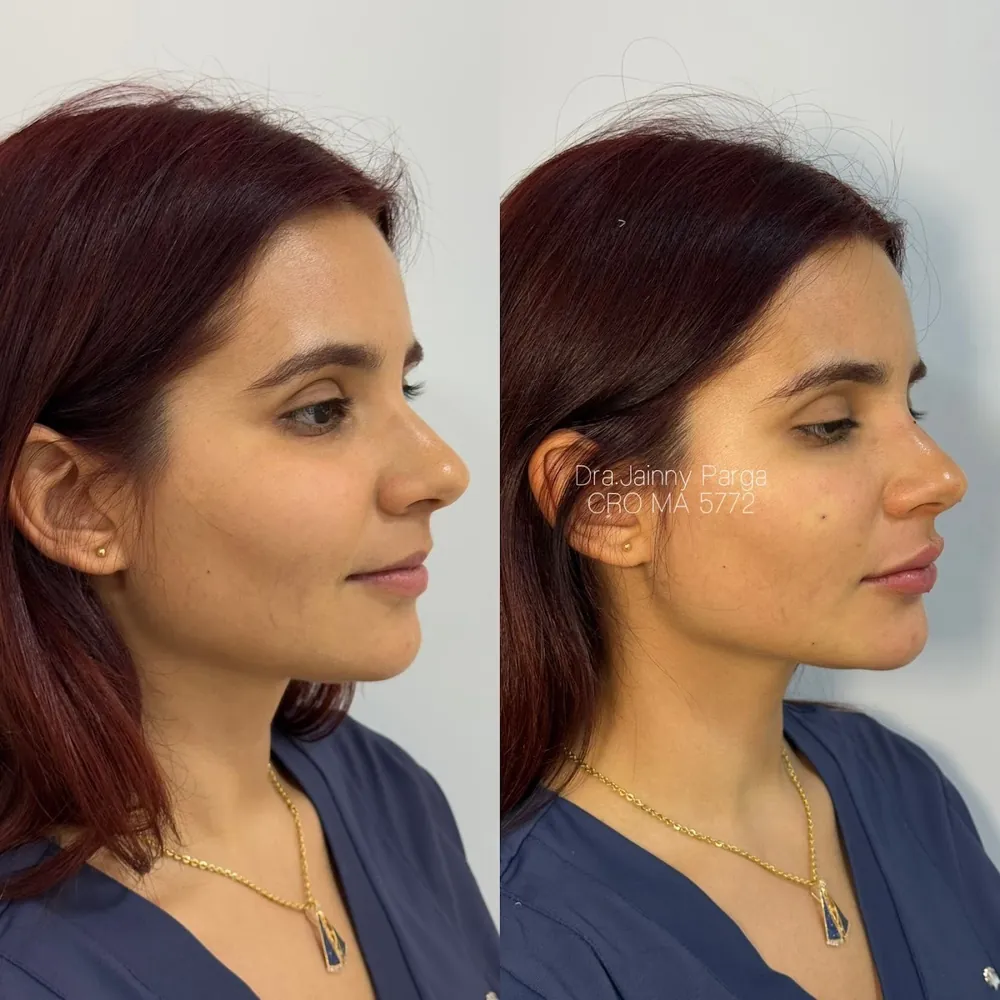 Perfil de paciente antes e depois da harmonização facial