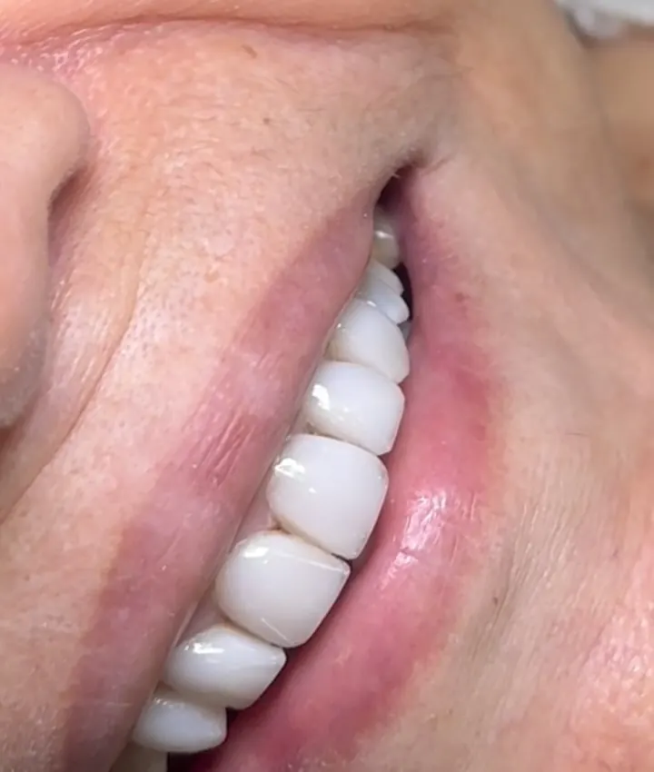 Sorriso com facetas em resina novas